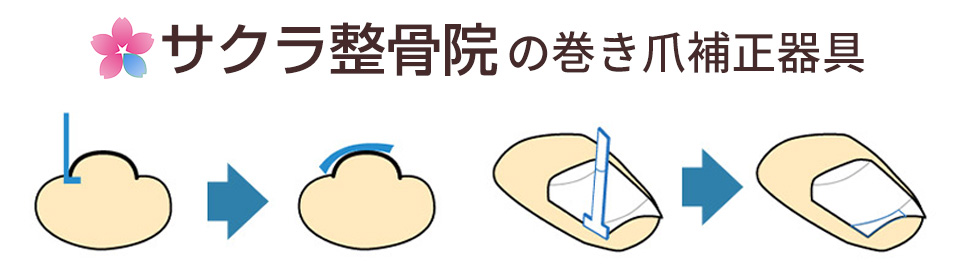 プレート施術
