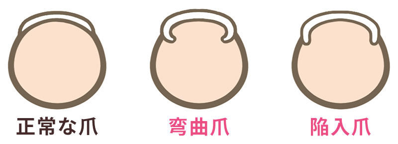 巻き爪タイプ